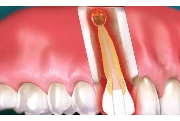 13. How Long Does a Root Canal Take1