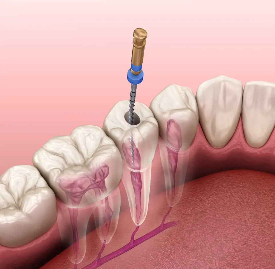 How Do You Know if You Need a Root Canal?