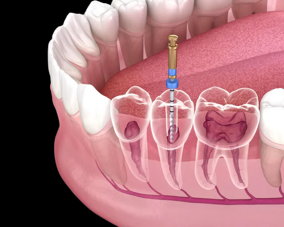 Six Things to Know About Root Canals | Dental Health Associates