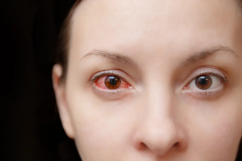 Can You Get Pink Eye From A Swimming Pool How To Avoid The Smart 