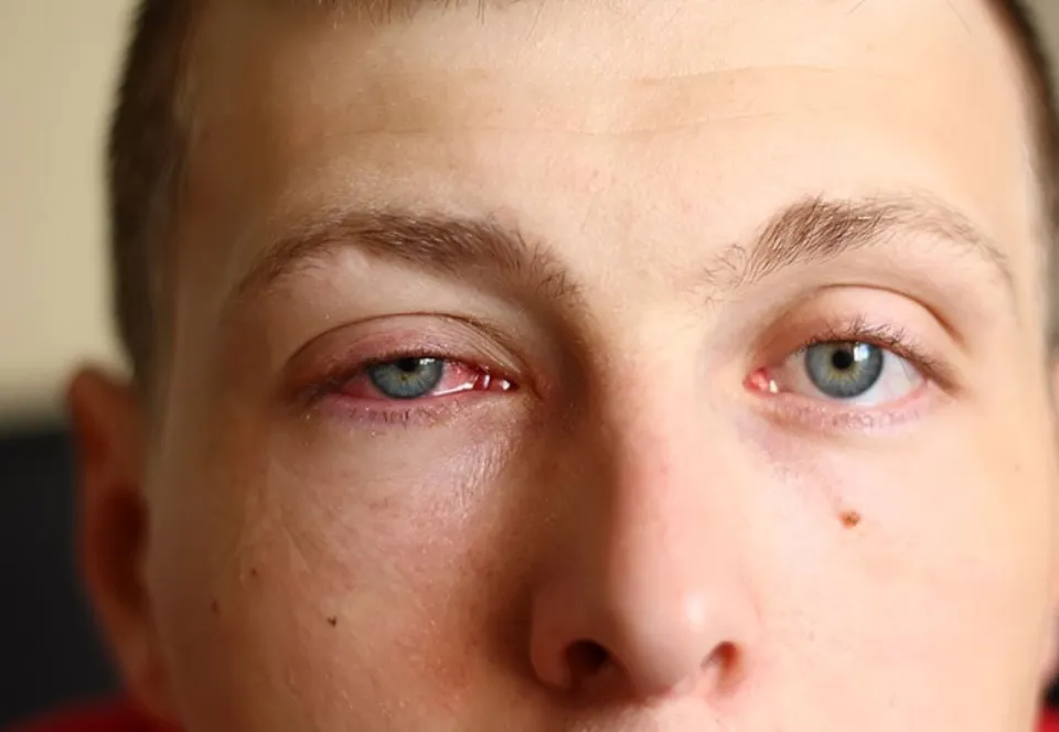 Can You Get Pink Eye from a Swimming Pool - How to Avoid?