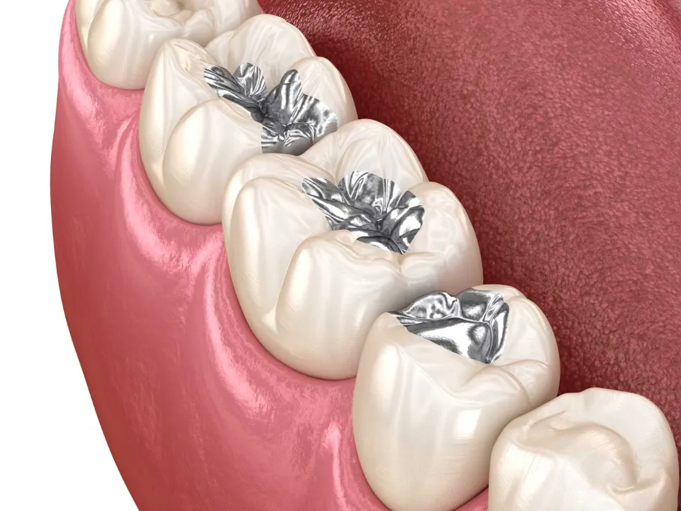 How Long Does It Take To Fill A Cavity - How Does It Work?
