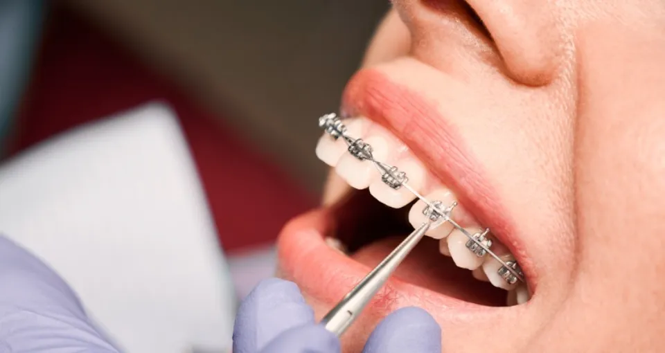 How to Know if You Need Braces - 5 Signs to Determine