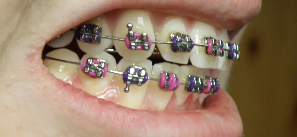 How to Know if You Need Braces - 5 Signs to Determine