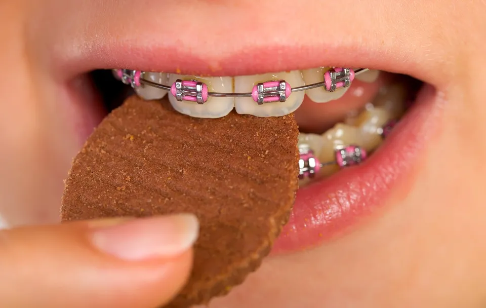 What Can I Eat with Braces - Everything You Should Know!