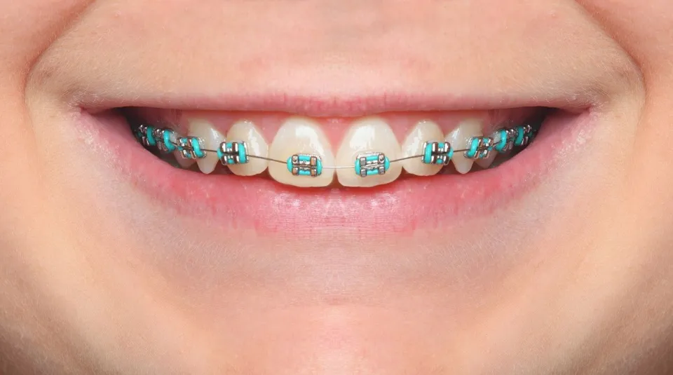 What Color Braces Should You Get - How to Pick?