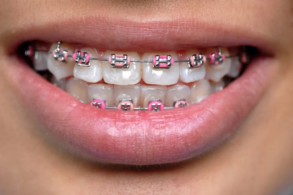 What Color Braces Should You Get - How to Pick?