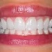 Can Braces Cause Gum Recession - What You Should Know