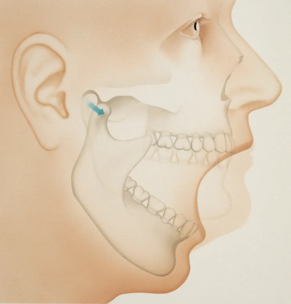 Can Braces Cause Temporomandibular Joint Dysfunction (TMJ)?