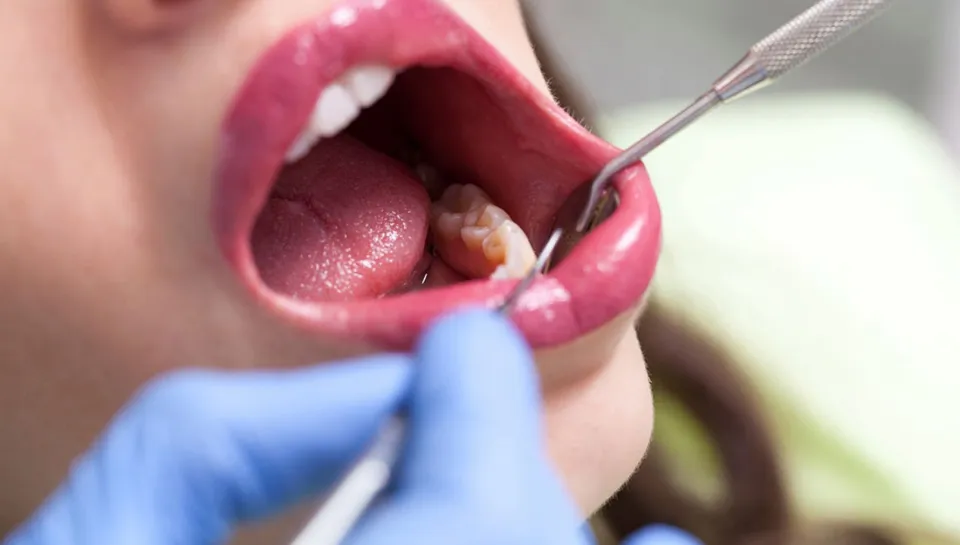 Can I Smoke Before Wisdom Tooth Extraction - What to Avoid?