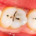 Cavity vs. Tooth Stain - Difference & How to Tell