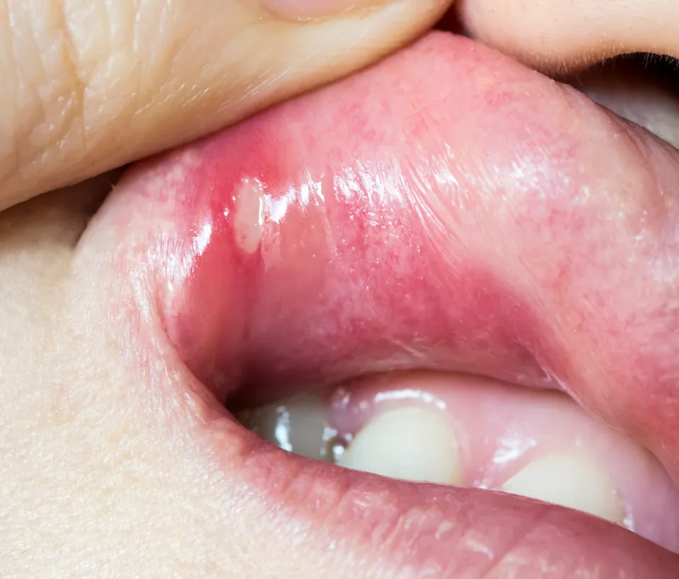Do Braces Cause Canker Sores - How to Deal with It?