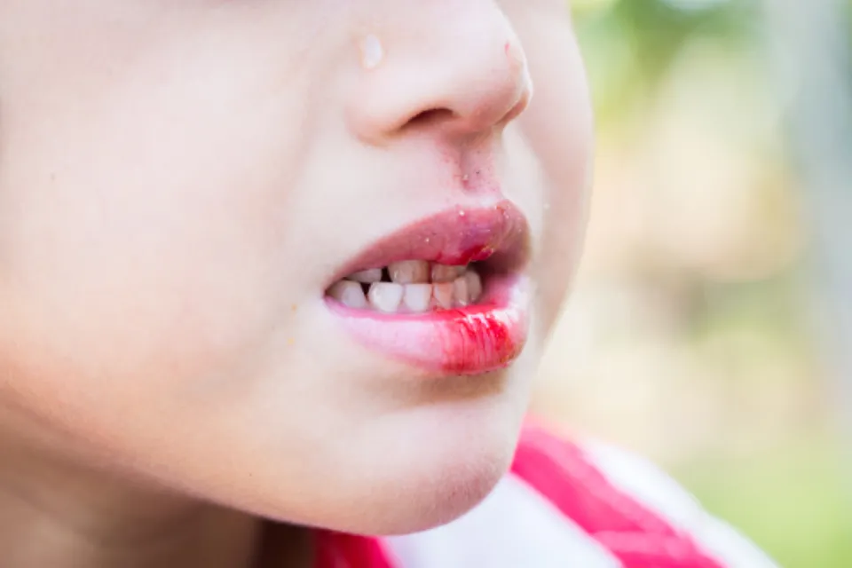 Do Braces Cause Canker Sores - How to Deal with It?