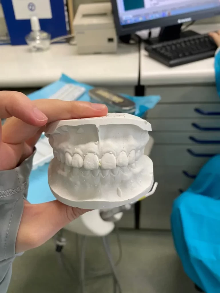 How Do Braces Fix An Overbite - How Does It Work?