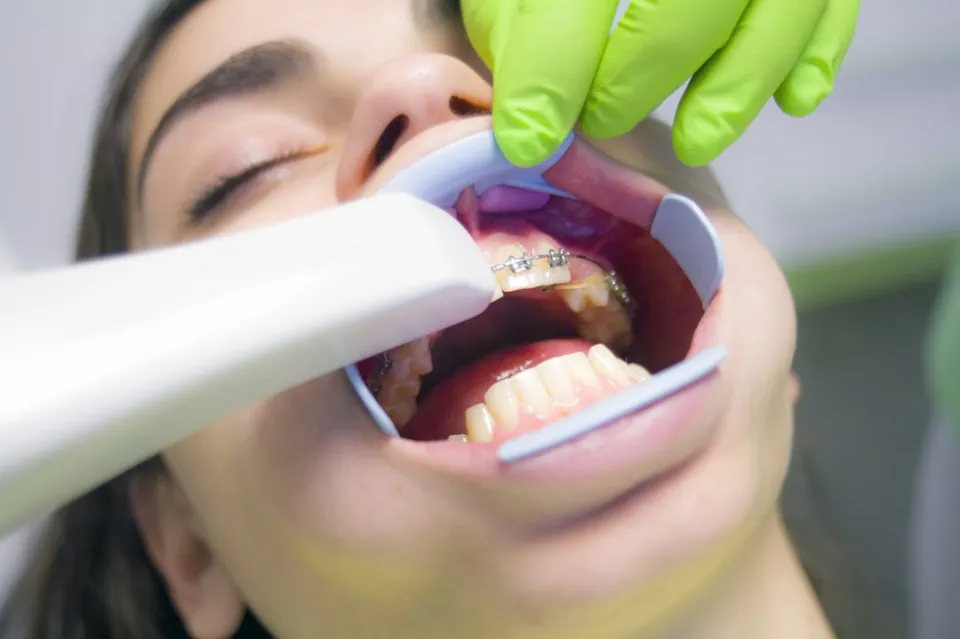 How Long Does It Take To Whiten My Teeth - Unveiling the Timeline
