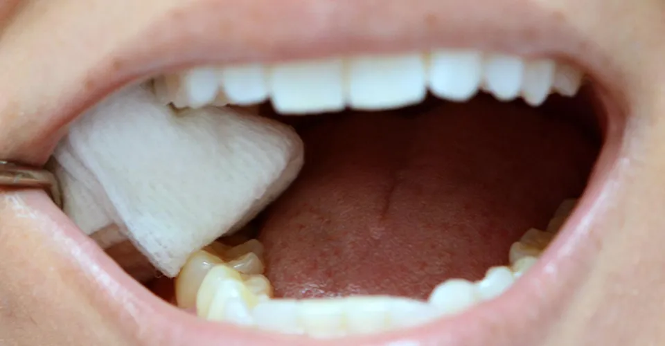 How Long To Use Gauze In After Wisdom Teeth Extraction