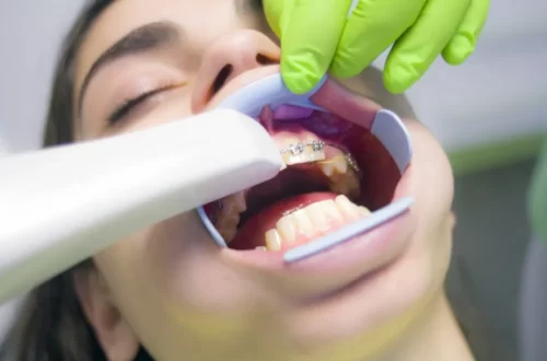 How Often Should You Go To The Orthodontist After Braces?