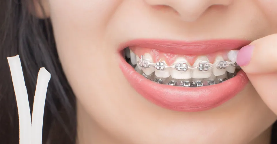 How To Use Wax For Braces - How Long Should You Leave Wax