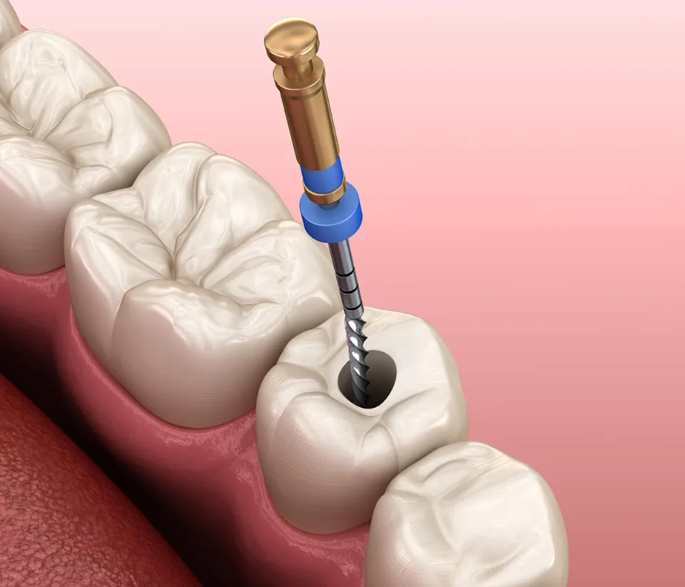 How to Avoid Root Canal - 4 Ways to Prevent