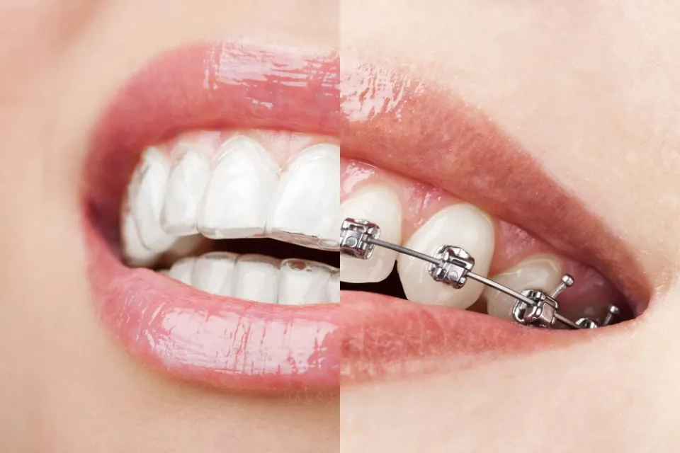 Invisalign vs. Traditional Braces - Which One Is Cheaper?