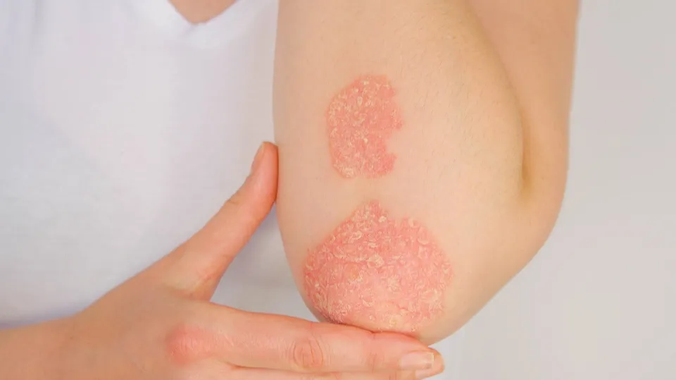 Is Vaseline Good For Psoriasis - What to Avoid?