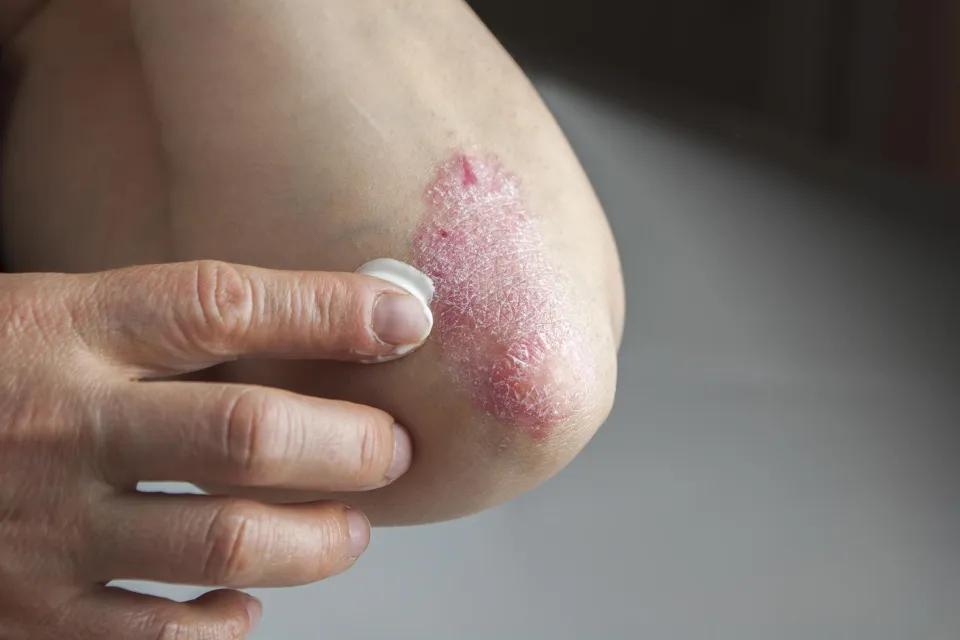 Is Vaseline Good For Psoriasis - What to Avoid?