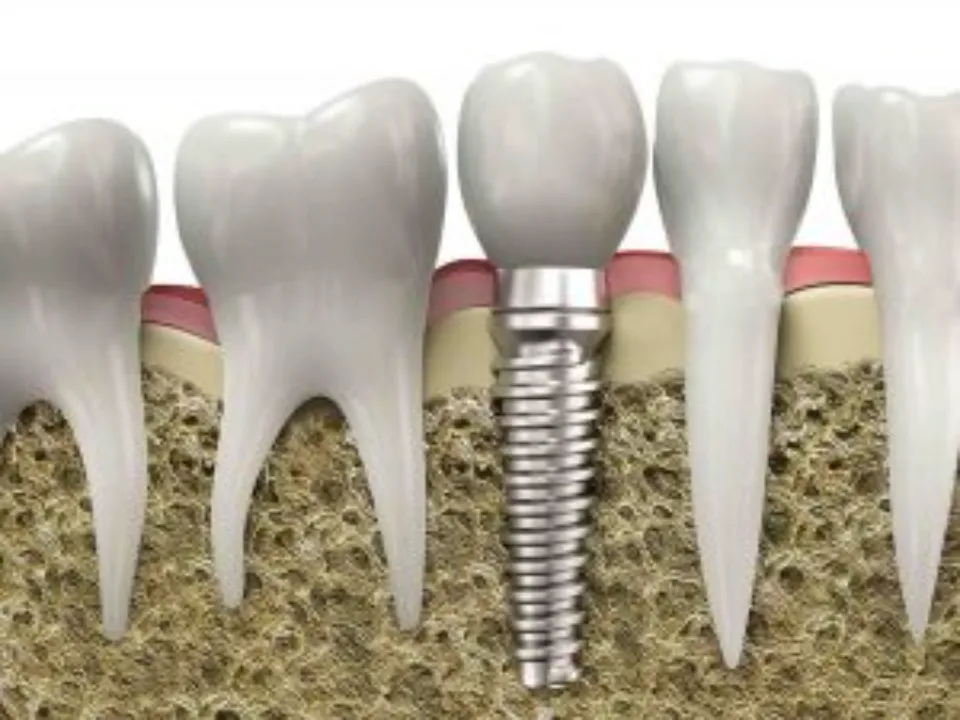 Pros and Cons of Dental Implants - Costs & Treatment