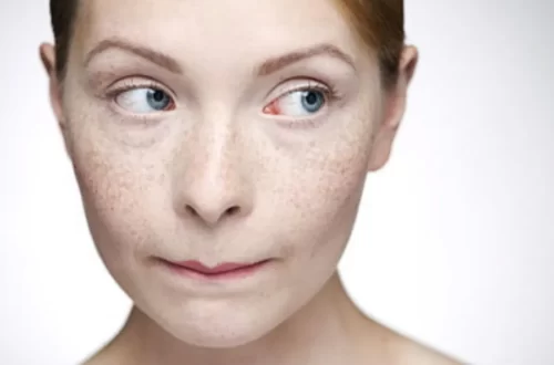 Sun Spots vs. Freckles - Difference & How to Treat