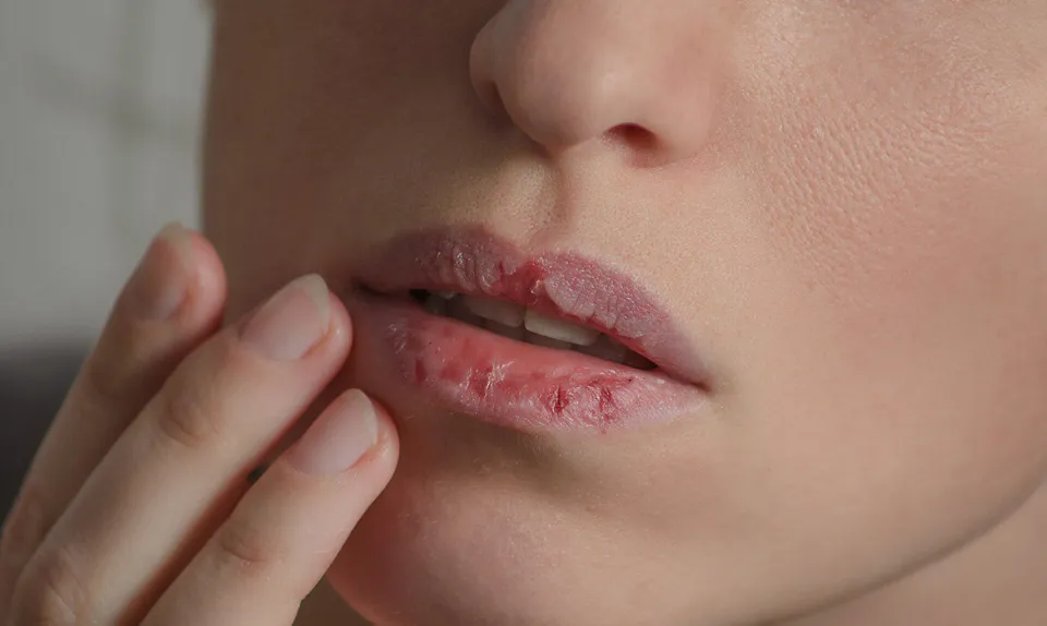 Vaseline for Chapped Lips - Is It Really Work?