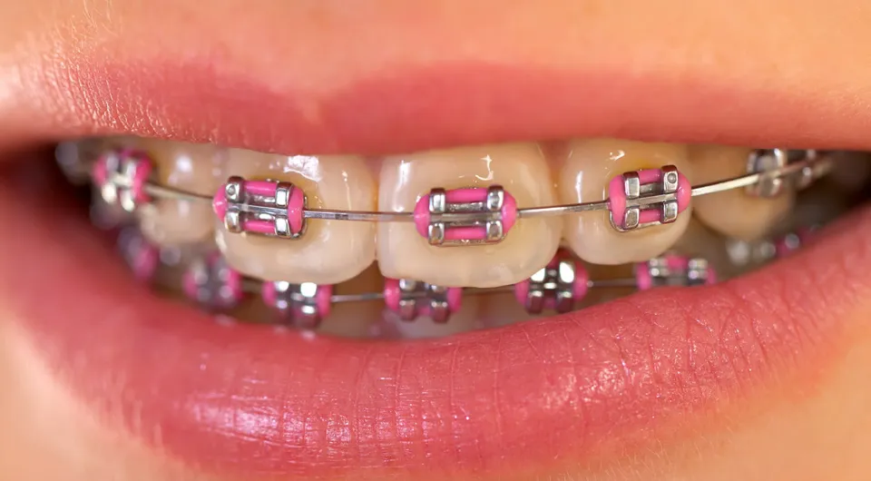 What Color Braces Make Your Teeth Look Whiter - 2023 Guide