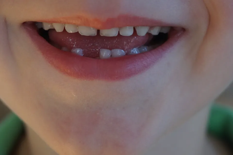 What to Do With Gaps in Your Baby's Front Teeth - Bridging the Gap