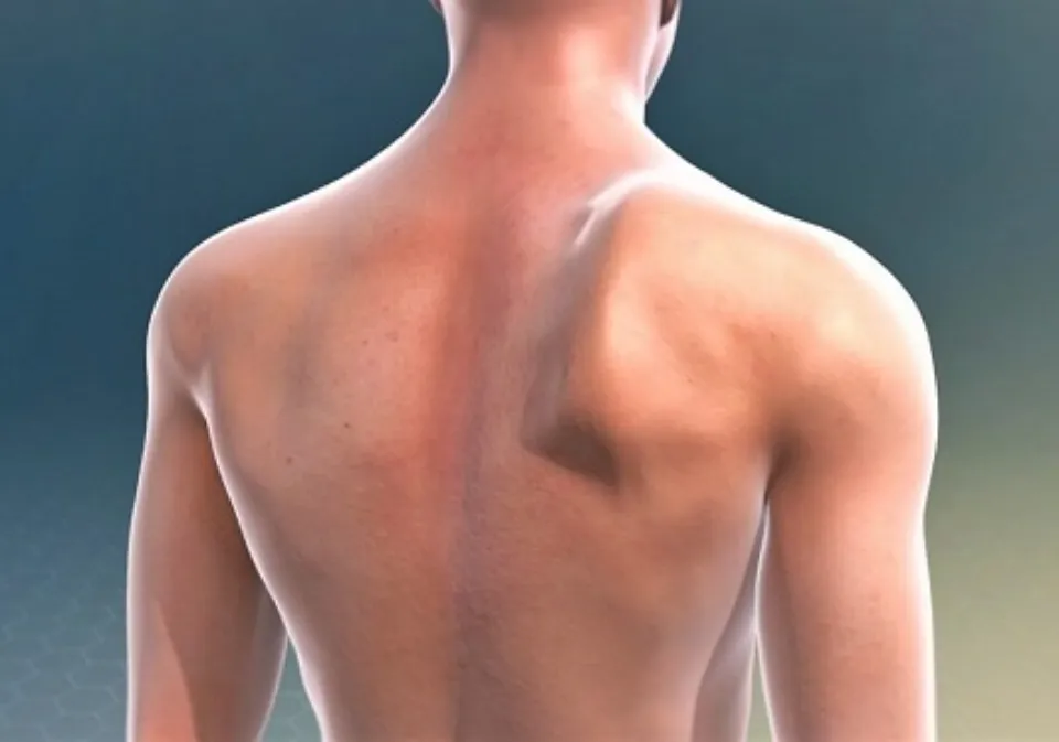 Why Do My Shoulder Blades Sticking Out - Causes & How to Fix