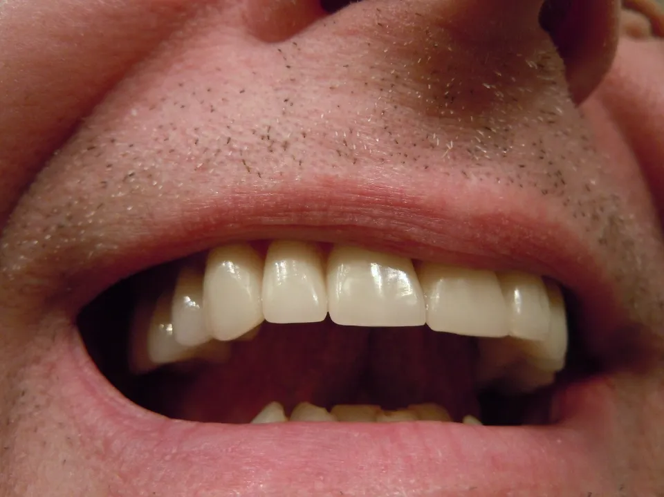 Why Do My Teeth Shift After Braces - How to Fix It?