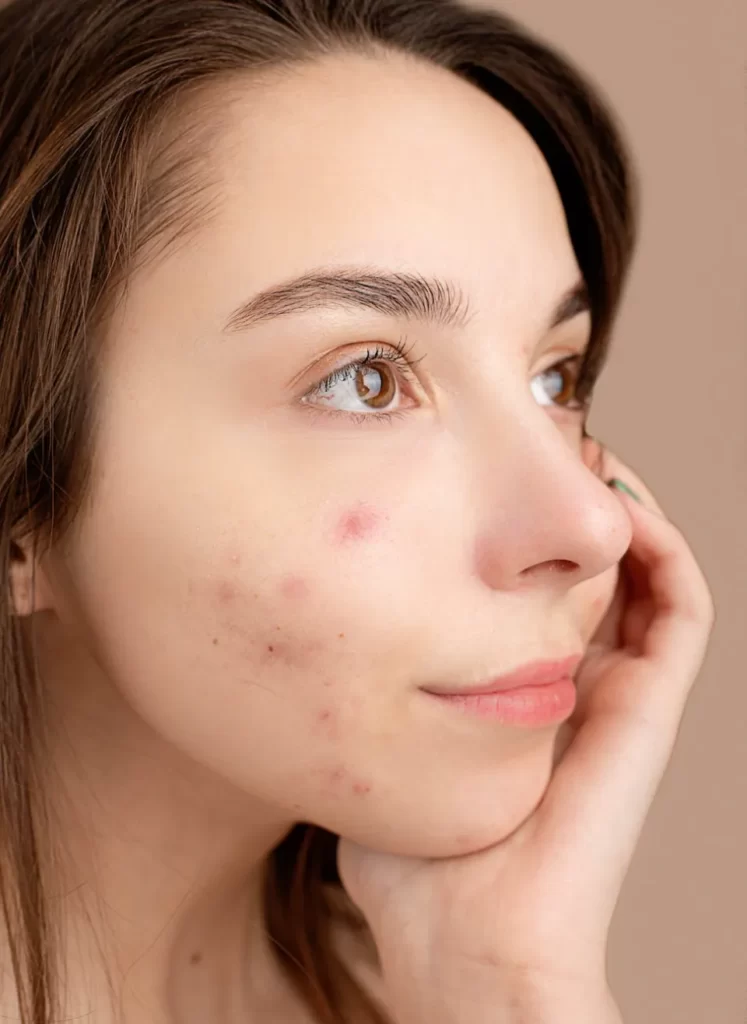 Acne Marks vs Acne Scars - Characteristics & Treatments