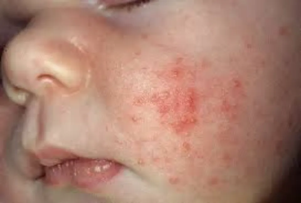 Baby Eczema vs. Acne - Unraveling Baby Skin Conditions