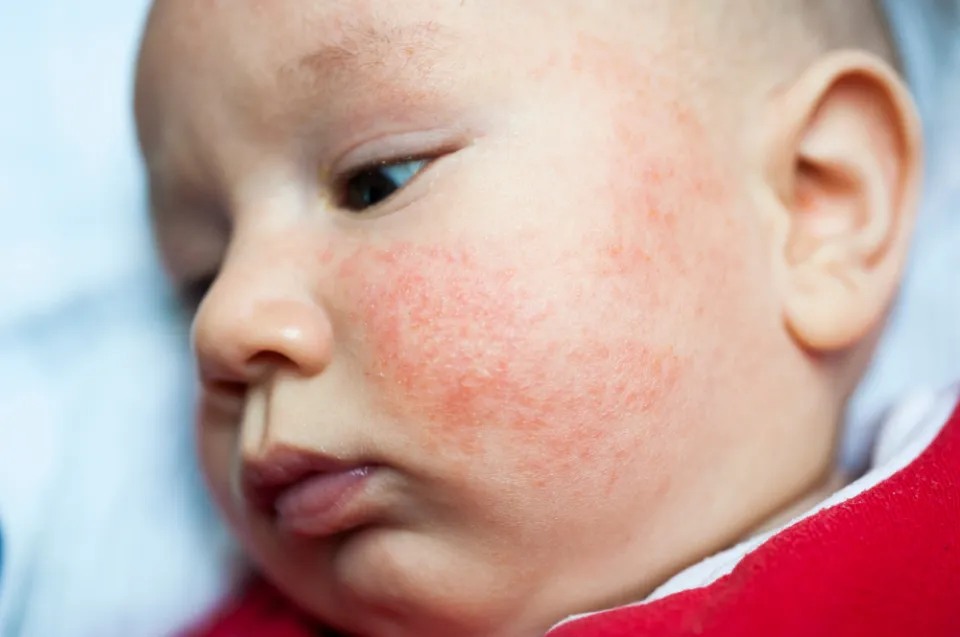 Baby Eczema vs. Acne - Unraveling Baby Skin Conditions