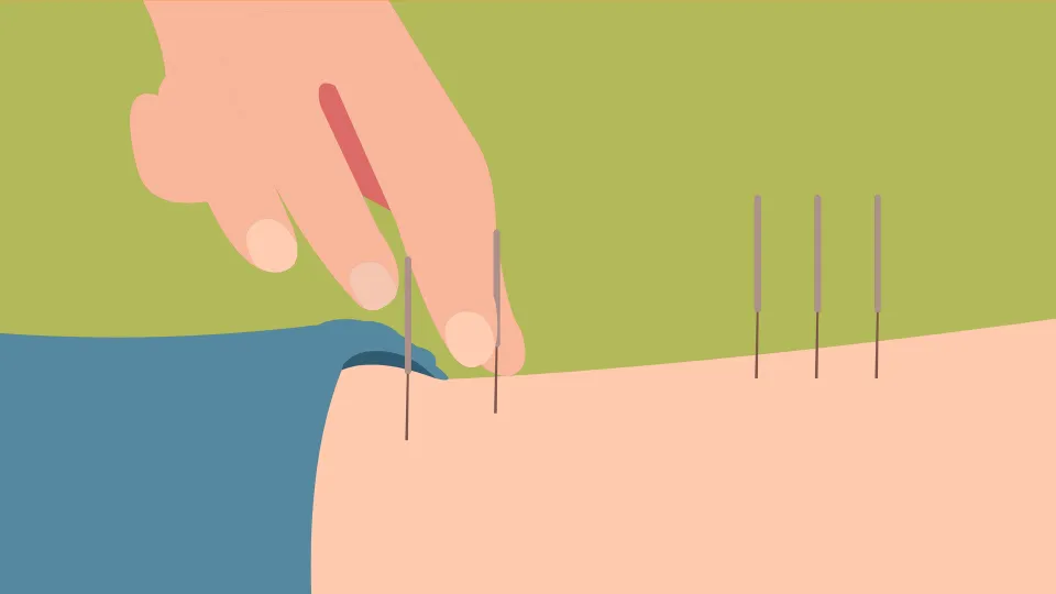 Does Acupuncture Detox The Body - Myth or Reality?