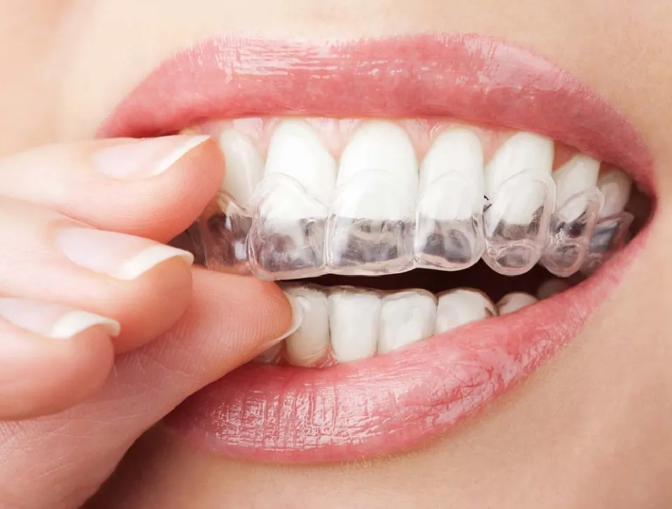 Herbaluxy Teeth Whitening Reviews - Unveiling the Secrets of a Radiant Smile