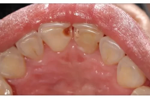 Holes in Teeth That Aren't Cavities - Understanding Enamel Defects