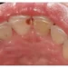 Holes in Teeth That Aren't Cavities - Understanding Enamel Defects