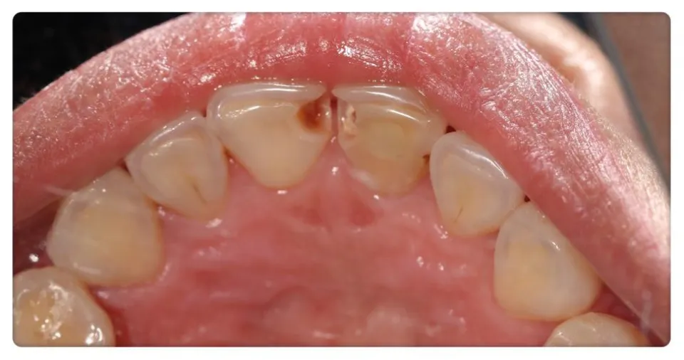 Holes in Teeth That Aren't Cavities - Understanding Enamel Defects