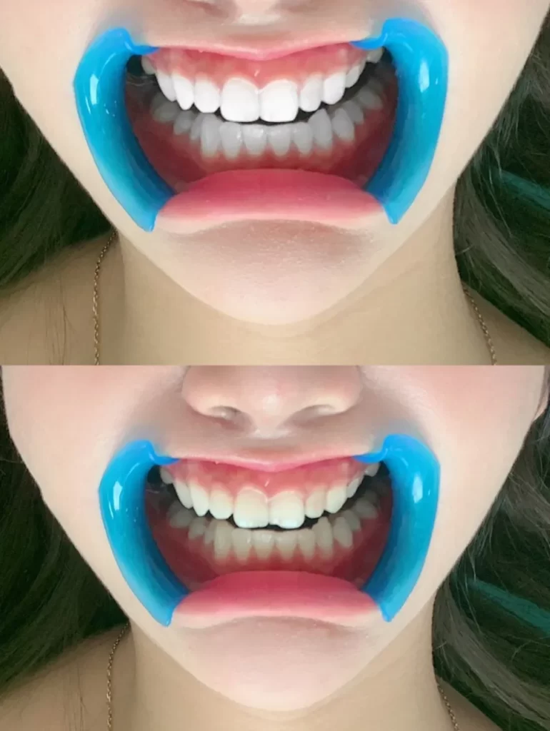 How Often Should I Use Whitening Strips - Brightening Your Smile