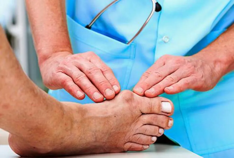 Is Bunion Surgery Covered by Insurance - What You Need to Know