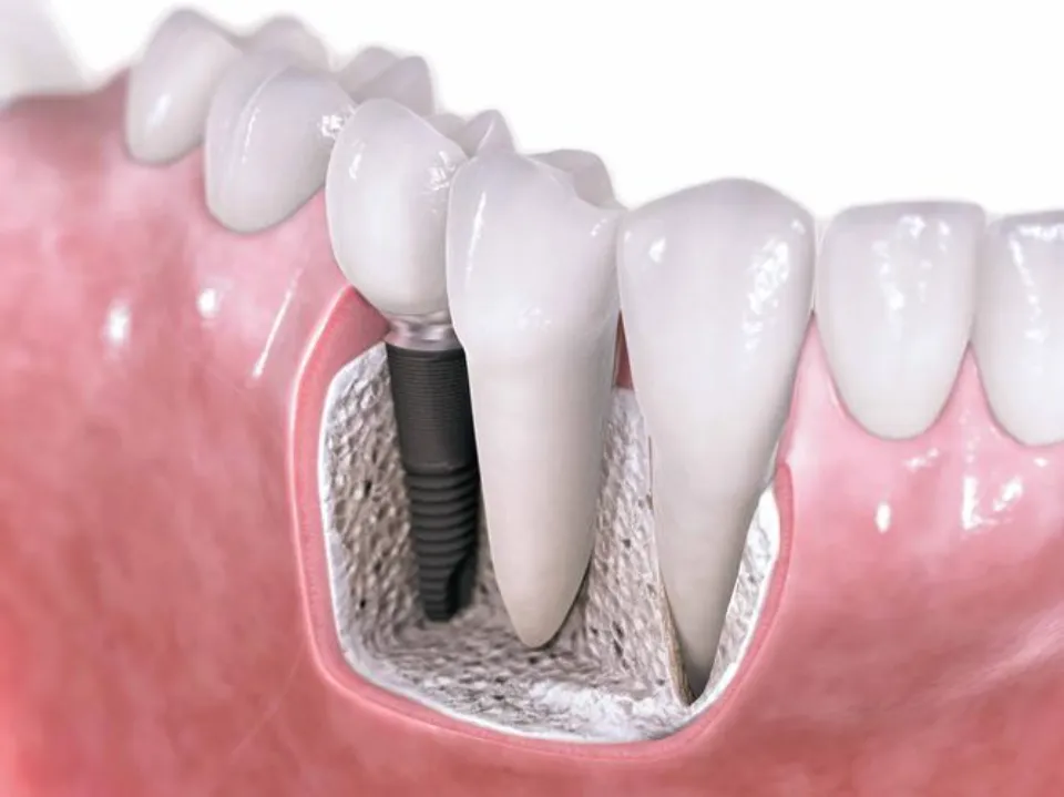 Pros and Cons of Clear Choice Dental Implants - 2023 Guide