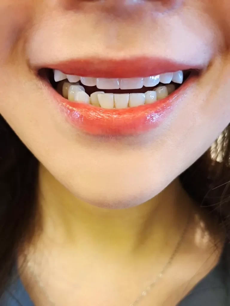 Sharp Canine Teeth Attractive - Exploring Dental Aesthetics