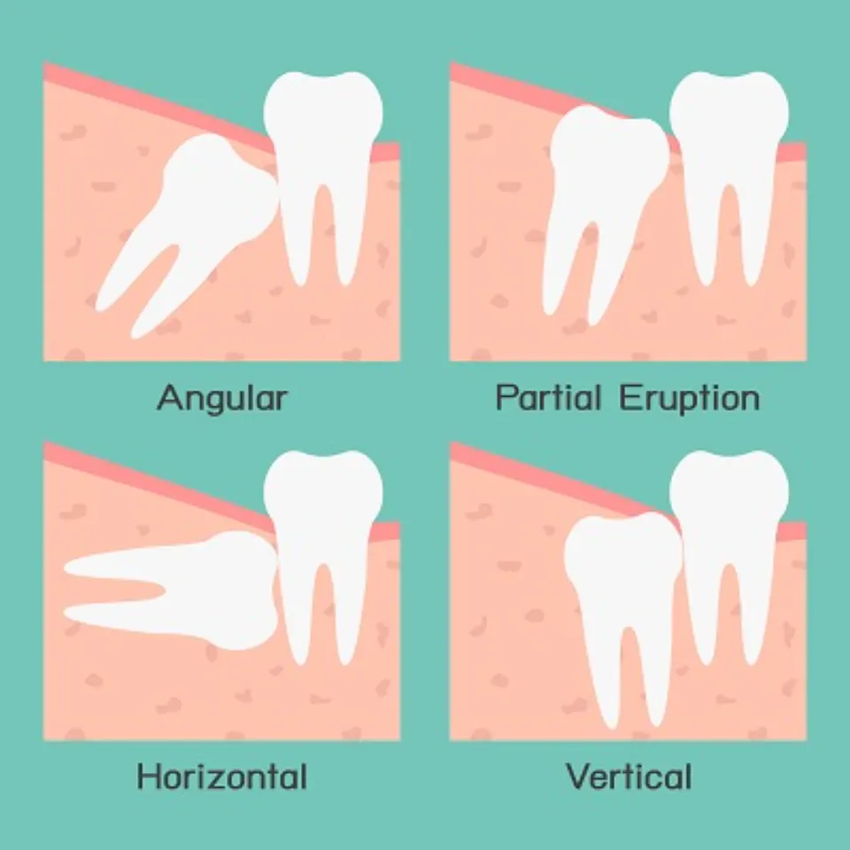What to Do Before Wisdom Teeth Removal - Essential Pre-operative Steps